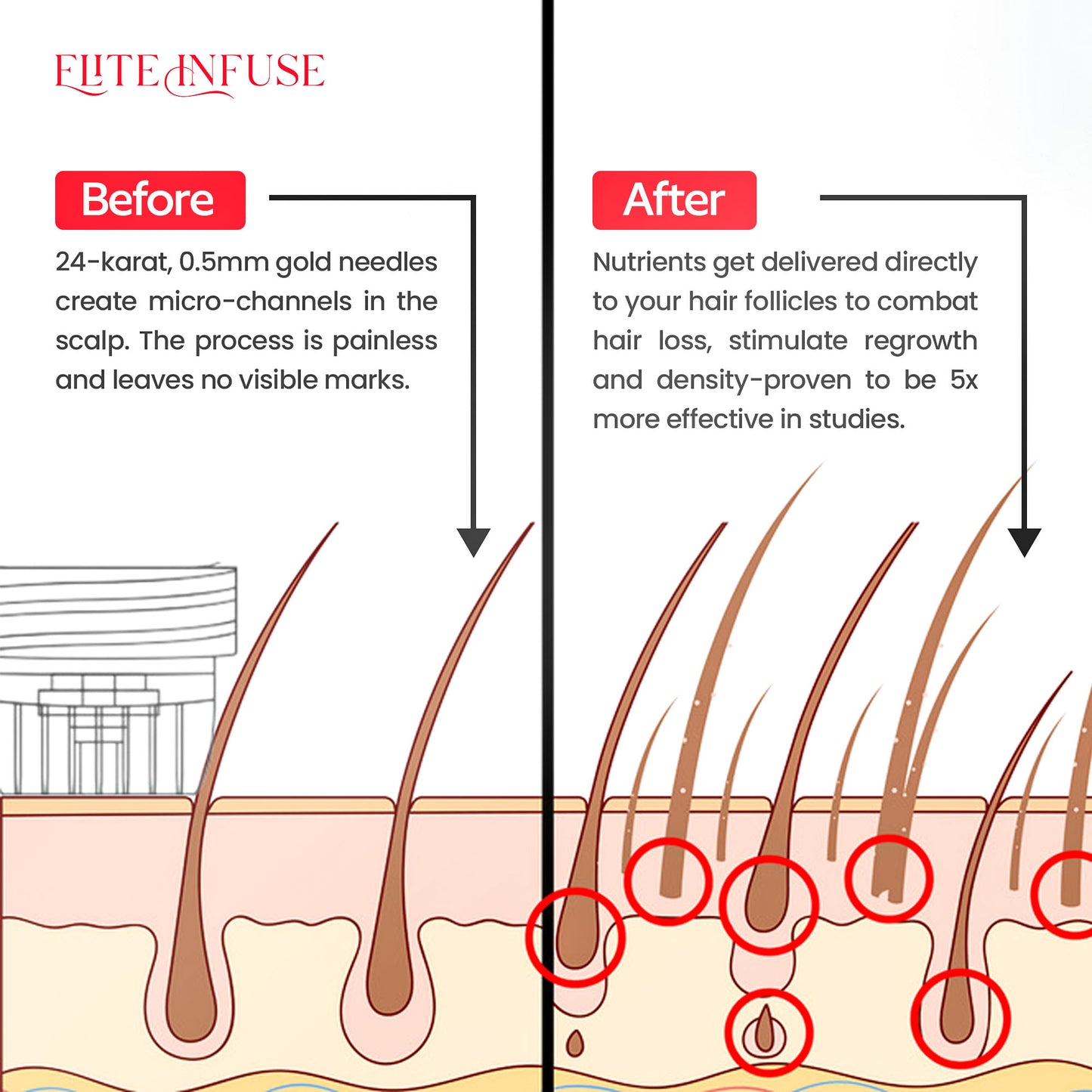 EliteInfuse™ Hair Regrowth System