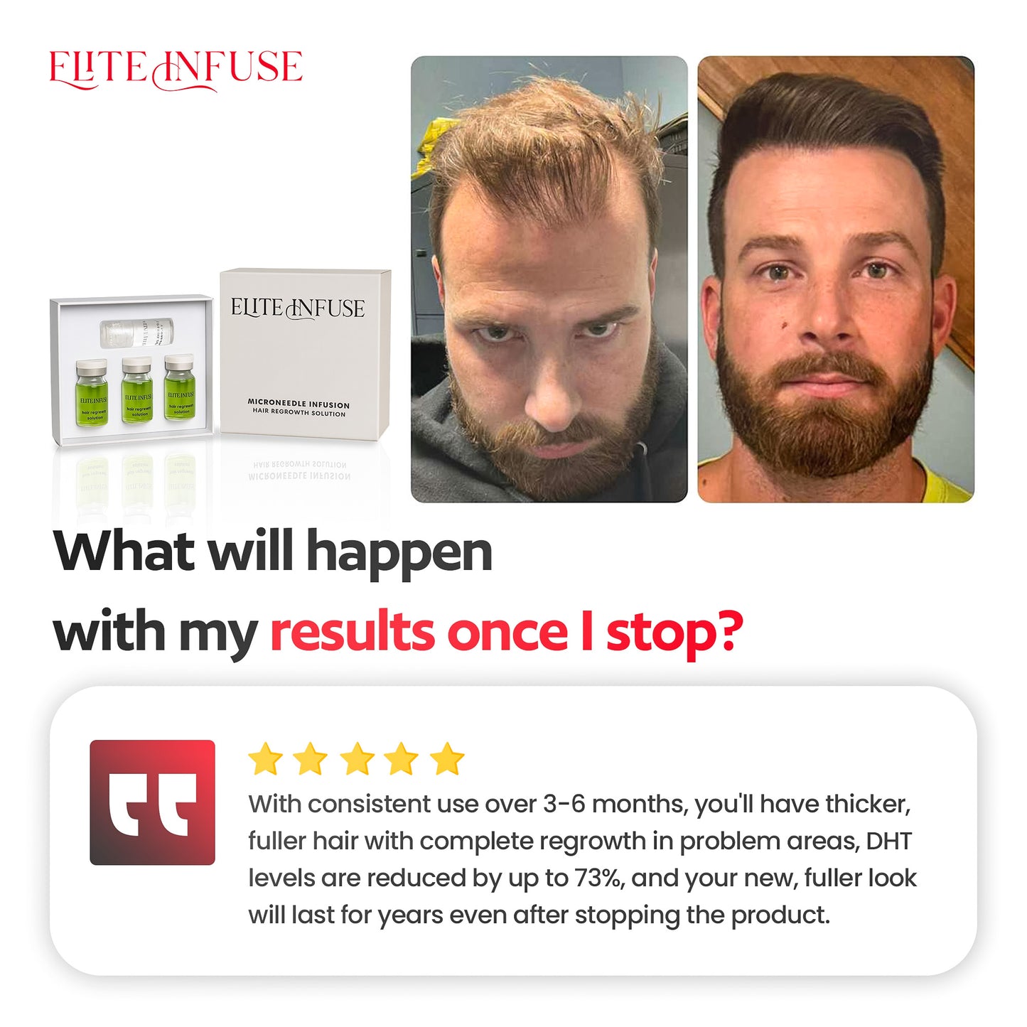 EliteInfuse™ Hair Regrowth System