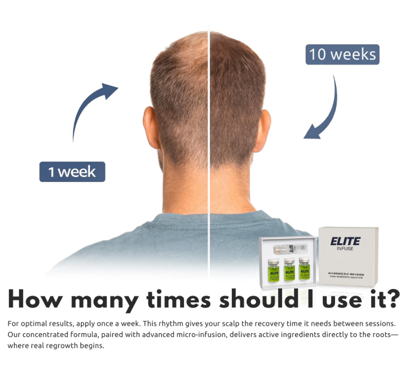 EliteInfuse™ Hair Regrowth System - Elite Infuse
