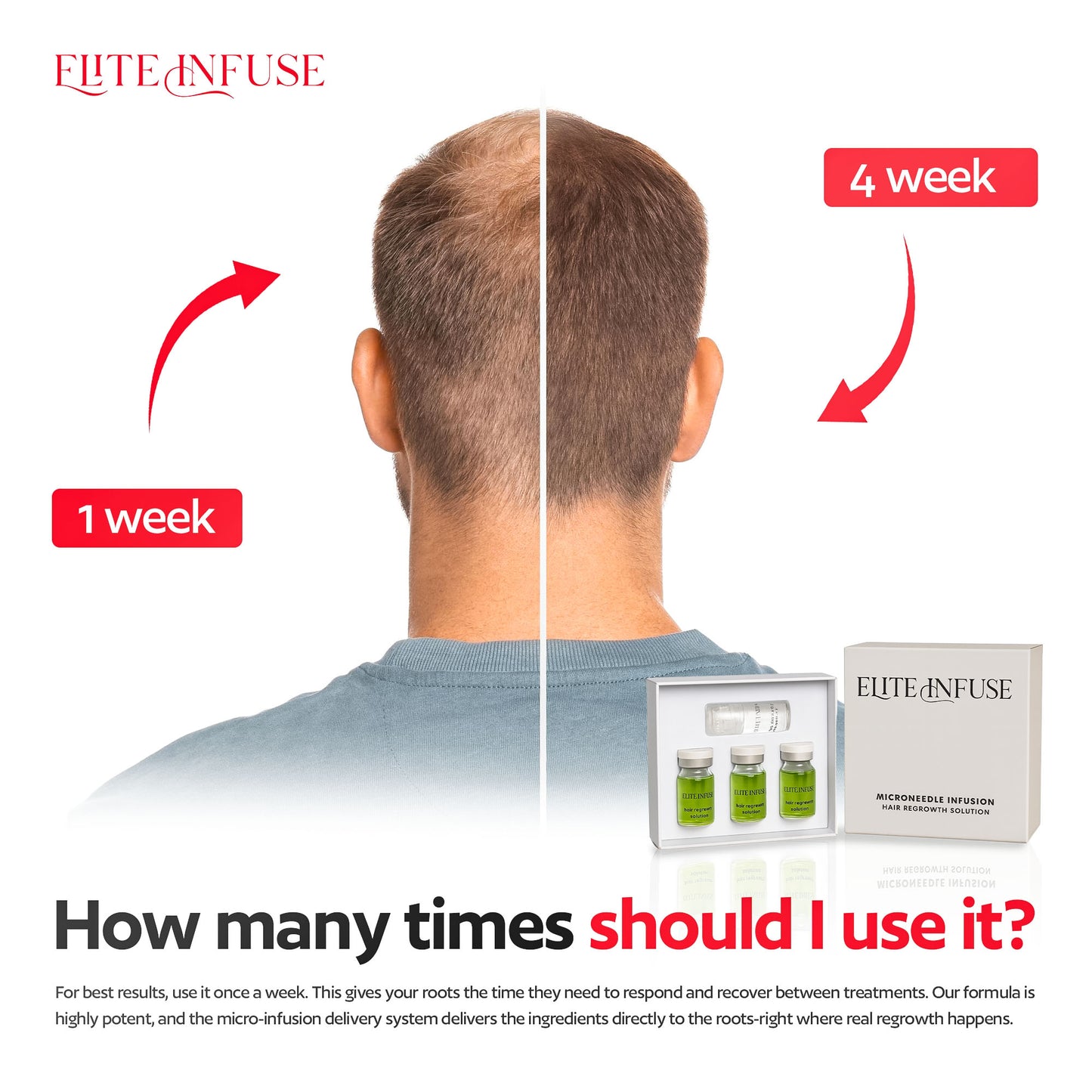 EliteInfuse™ Hair Regrowth System