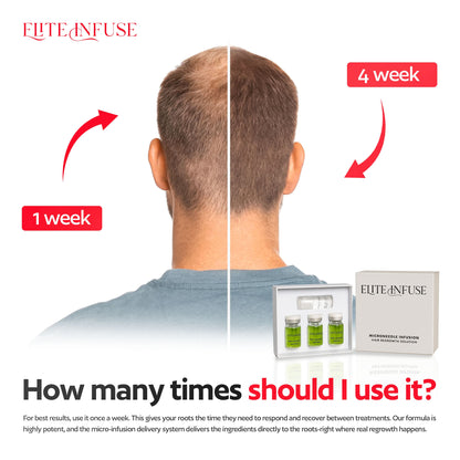 EliteInfuse™ Hair Regrowth System