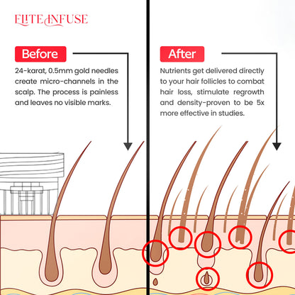 EliteInfuse™ Hair Regrowth System